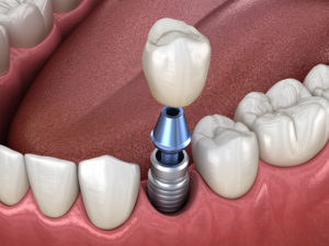 Premolar tooth crown installation over implant abutment. Medically accurate 3D illustration of human teeth and dentures concept