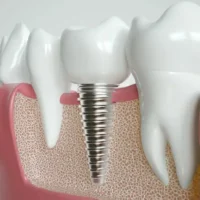 Dental Implants: Protecting Your Smile and Bone Health