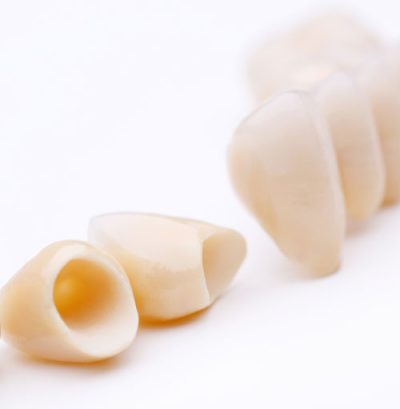 DetailDental_same-day-crowns